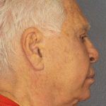 Facelift Before & After Patient #11809