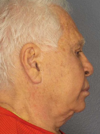 Facelift Before & After Patient #11809