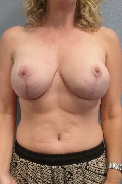 Augmentation Mastopexy Revision Before & After Patient #11283