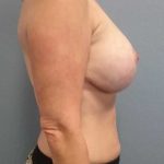Augmentation Mastopexy Revision Before & After Patient #11283