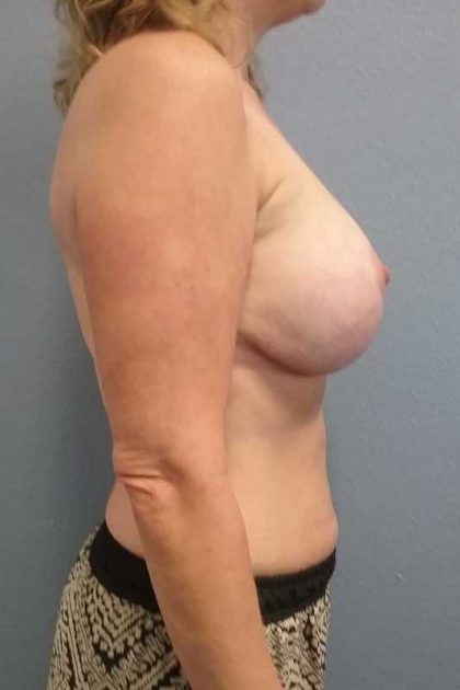 Augmentation Mastopexy Revision Before & After Patient #11283