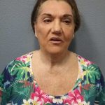 Facelift Before & After Patient #11831