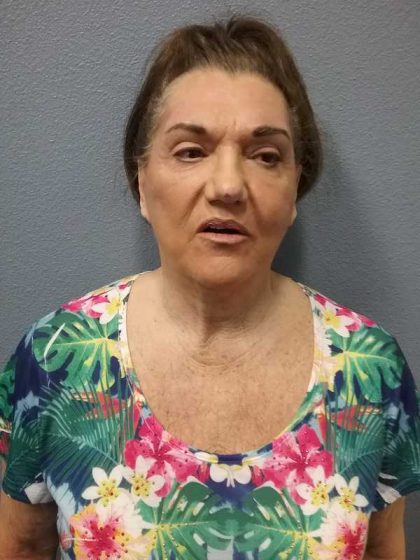 Facelift Before & After Patient #11831