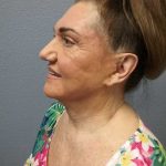 Facelift Before & After Patient #11831