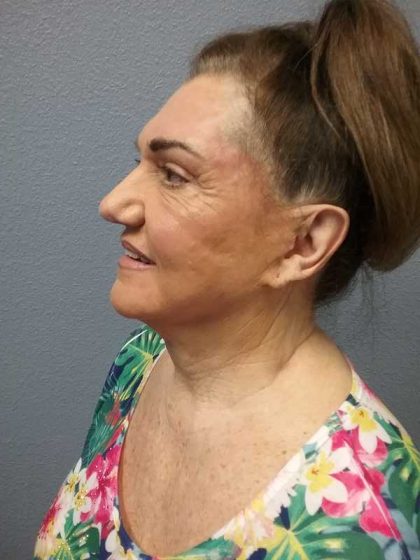 Facelift Before & After Patient #11831