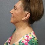 Facelift Before & After Patient #11831