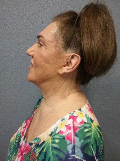 Facelift Before & After Patient #11831