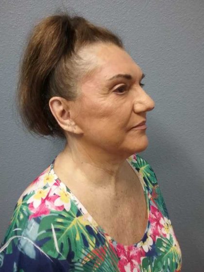 Facelift Before & After Patient #11831