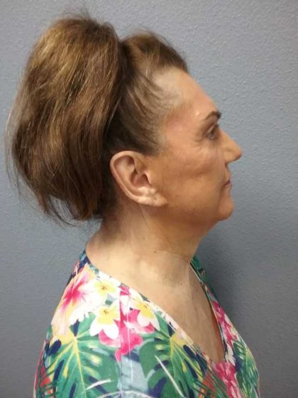Facelift Before & After Patient #11831