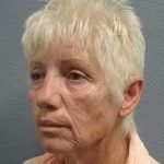 Facelift Before & After Patient #11736