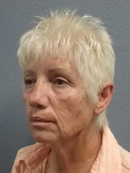 Facelift Before & After Patient #11736
