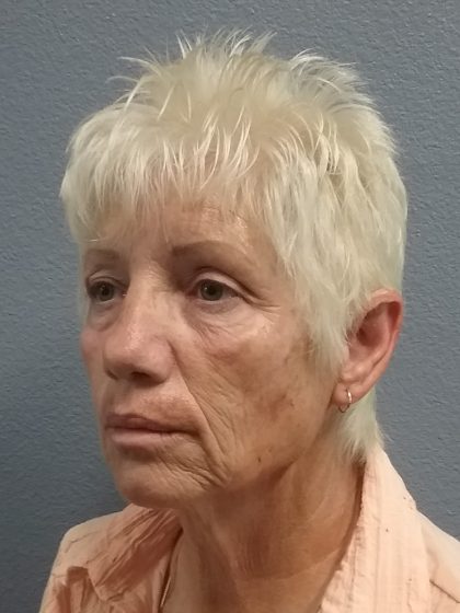 Facelift Before & After Patient #7521