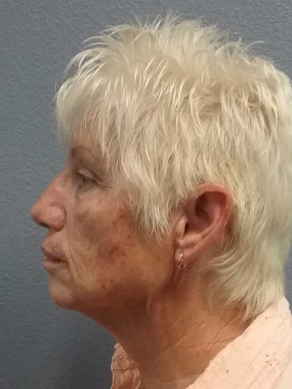 Facelift Before & After Patient #11736