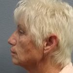Facelift Before & After Patient #7521