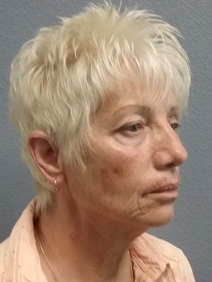 Facelift Before & After Patient #7521