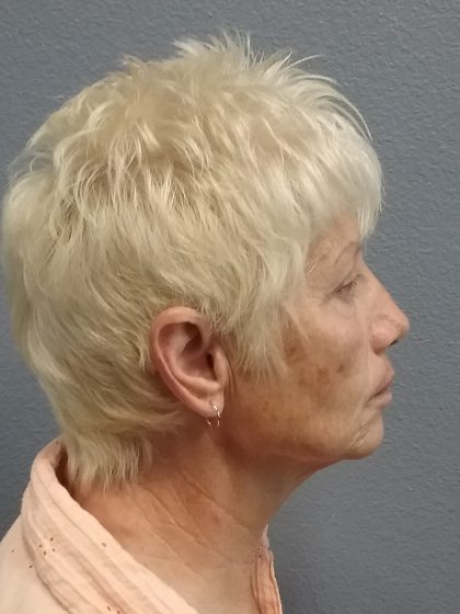 Facelift Before & After Patient #7521