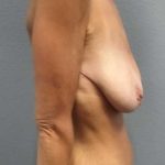 Breast Lift with Implant (Augmentation Mastopexy) Before & After Patient #11262