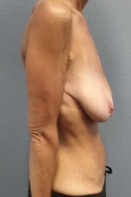 Breast Lift with Implant (Augmentation Mastopexy) Before & After Patient #11262