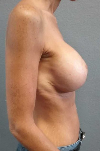 Breast Lift with Implant (Augmentation Mastopexy) Before & After Patient #11262