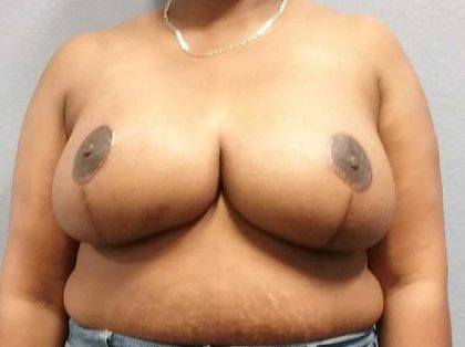 Breast Reduction Before & After Patient #11607