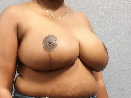 Breast Reduction Before & After Patient #11607