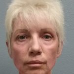 Facelift Before & After Patient #7521