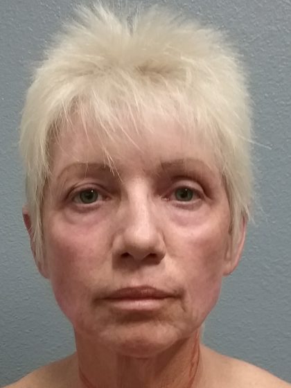 Facelift Before & After Patient #7521