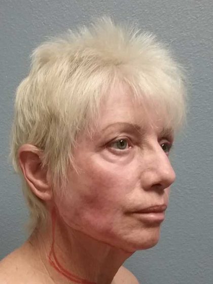 Facelift Before & After Patient #11736