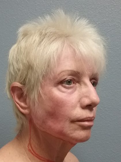 Facelift Before & After Patient #7521
