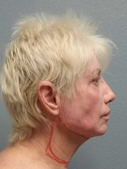 Facelift Before & After Patient #11736