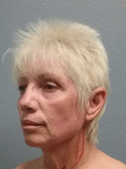 Facelift Before & After Patient #11736