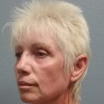 Facelift Before & After Patient #7521