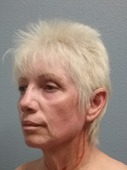 Facelift Before & After Patient #7521