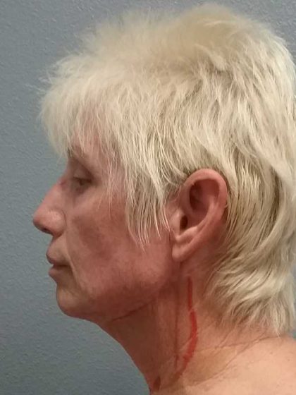 Facelift Before & After Patient #11736