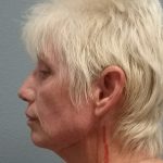 Facelift Before & After Patient #7521