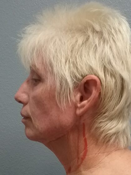 Facelift Before & After Patient #7521