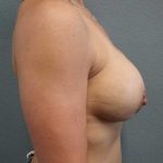 Mastopexy (Breast Lift) Before & After Patient #12221