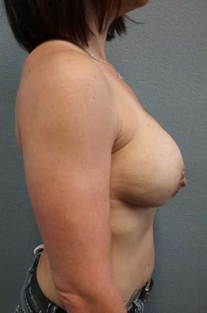 Mastopexy (Breast Lift) Before & After Patient #12221