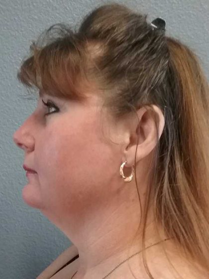 Liposuction of the Neck Before & After Patient #12214