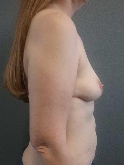 Breast Augmentation Before & After Patient #5375