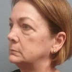 Facelift Before & After Patient #11705
