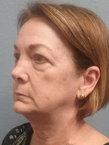 Facelift Before & After Patient #11705