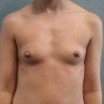 Breast Augmentation Before & After Patient #11538
