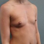 Breast Augmentation Before & After Patient #11538
