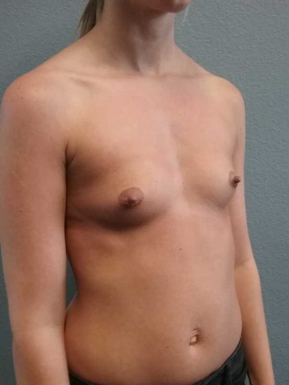 Breast Augmentation Before & After Patient #11538