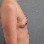 Breast Augmentation Before & After Patient #11538