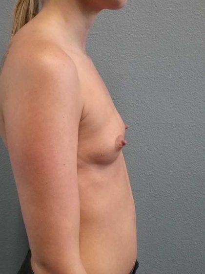 Breast Augmentation Before & After Patient #11538