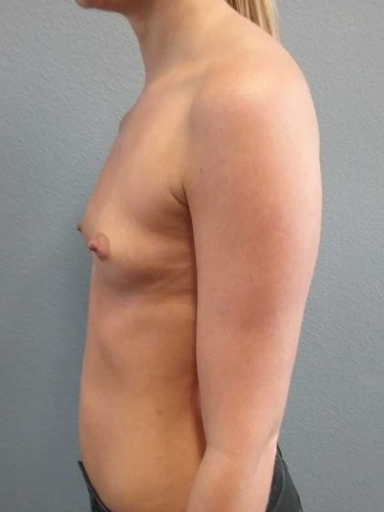 Breast Augmentation Before & After Patient #11538