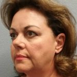 Facelift Before & After Patient #11914