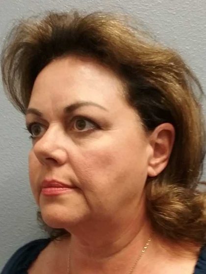 Facelift Before & After Patient #11914
